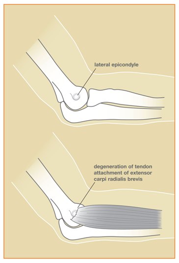 Figure 1: The muscle involved in this condition, the extensor carpi radialis brevis, helps to extend and stabilize the wrist