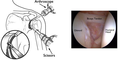 Shoulder Arthoscopy Image 3